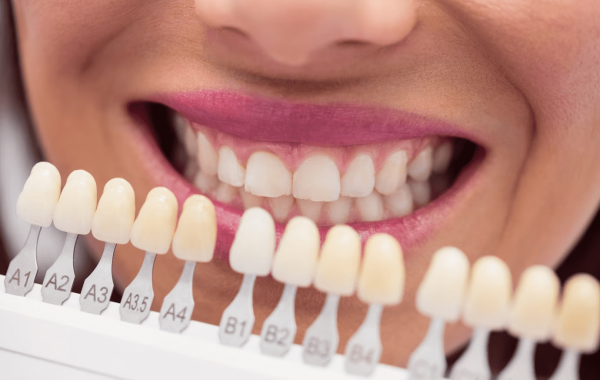 Teeth Whitening in Malaysia: A Bright Path to a Confident Smile